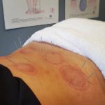 Sports Recovery Acupuncture: Uncover 6 Key Advantages
