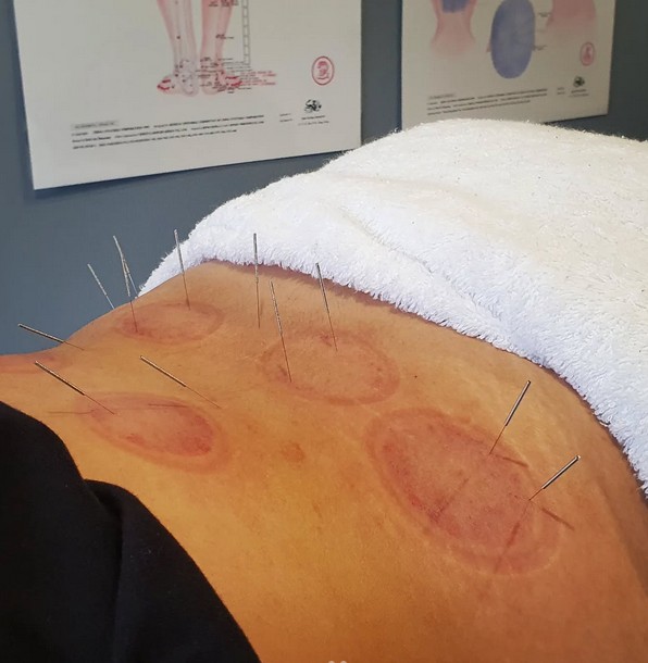 Sports Recovery Acupuncture: Uncover 6 Key Advantages