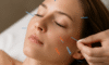 Cosmetic Acupuncture: Essential Disadvantages to Weigh Up